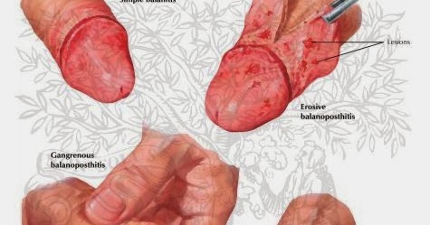 Candidiasis glande y prepucio